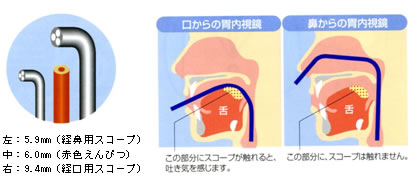 上部消化管内視鏡検査（胃カメラ）