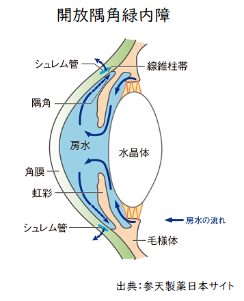 開放隅角緑内障