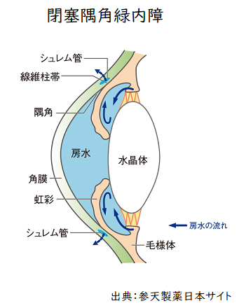 閉塞隅角緑内障